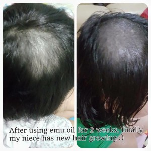 niece hair loss