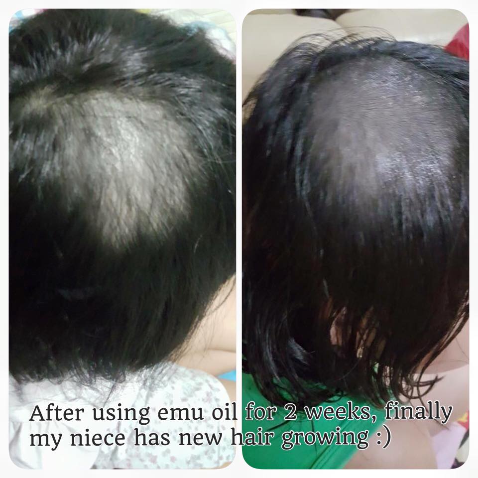 Emu Oil for Hair Loss | Emuse ~ Pure Emu Oil Singapore Since 2011