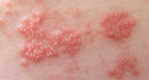 388x210_Shingles_vs_Psoriasis